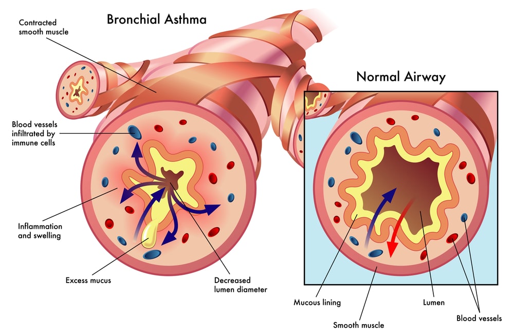 Illustration comparing a normal airway and one affected by bronchial asthma in asthma pulmonology, highlighting differences in muscle contraction, mucus, and inflammation.